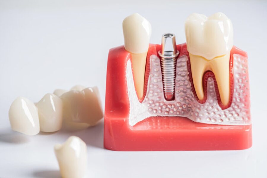 Dental implant model showing titanium screw fixture between natural teeth on pink gum replica.