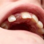 pediatric dental crowns Austin