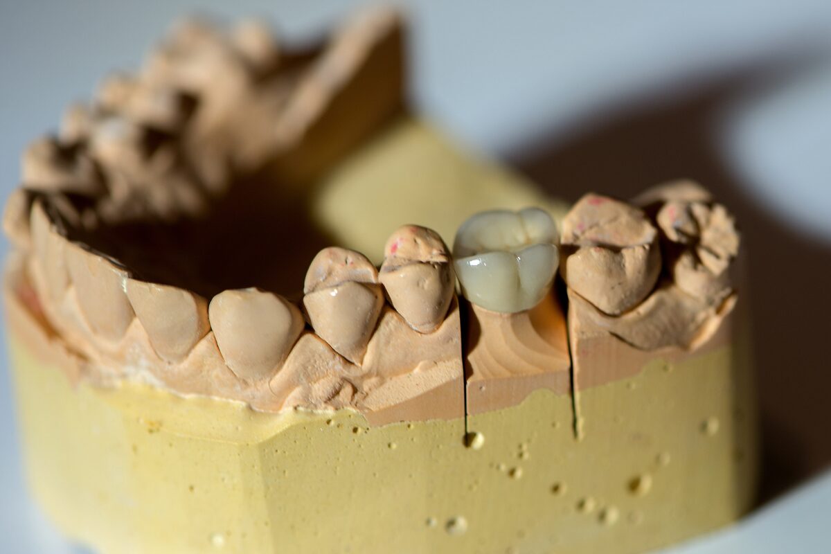 Pediatric Dental Crowns Austin