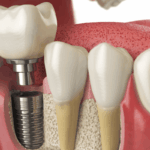 dental crowns austin
