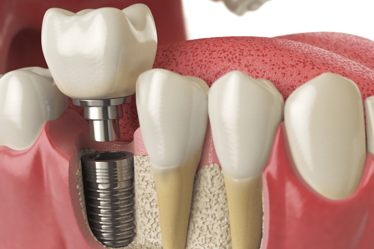 dental crowns austin