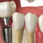 pediatric dental crowns in Austin