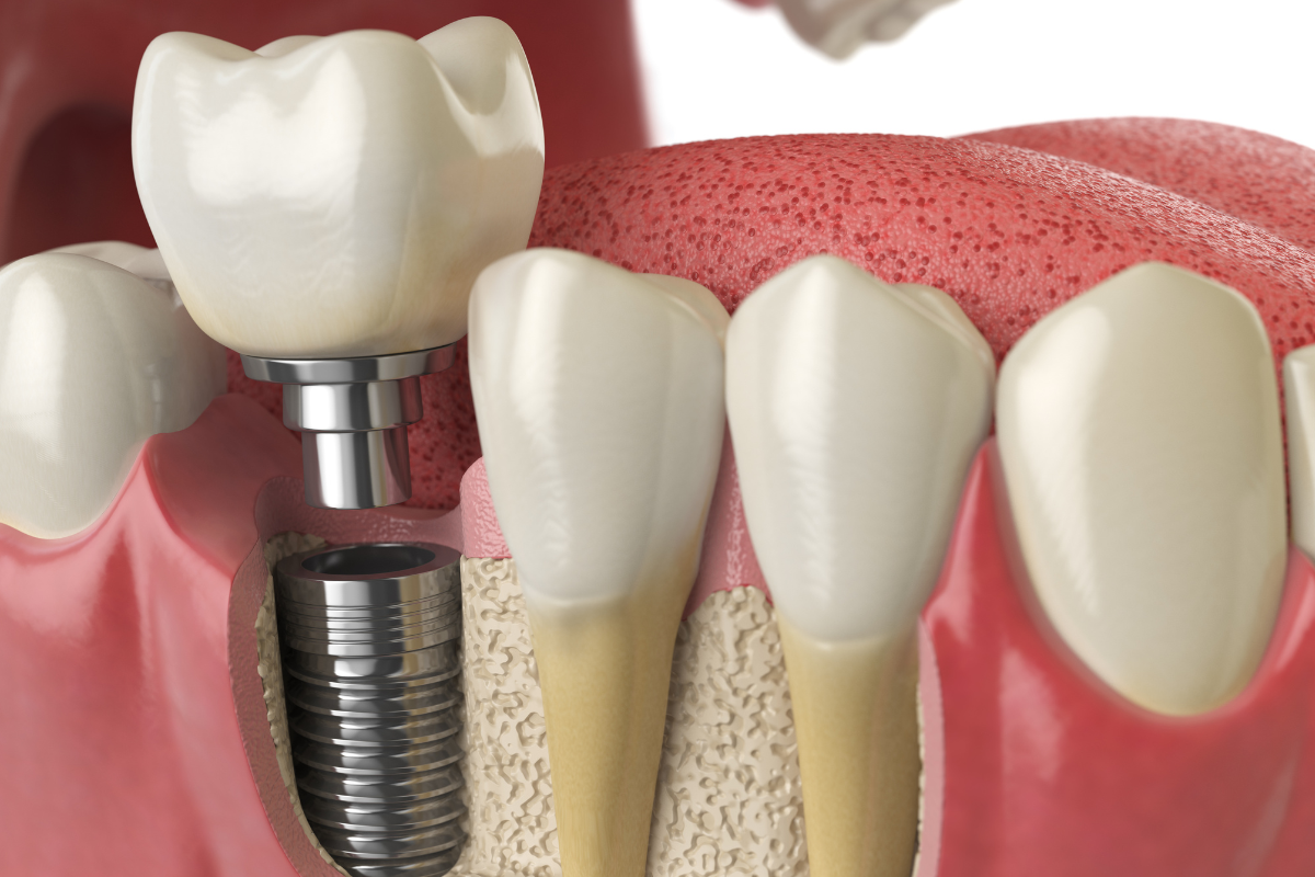 pediatric dental crowns in Austin