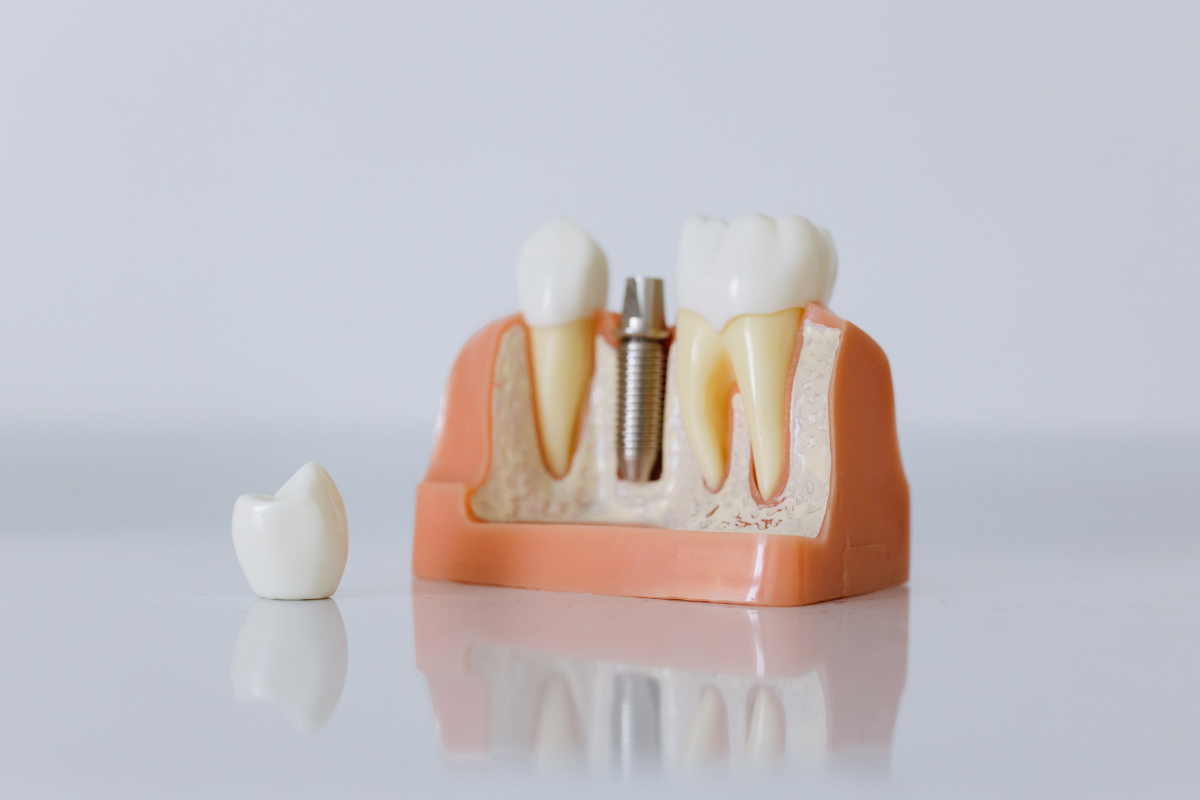 pediatric dental crowns in Austin
